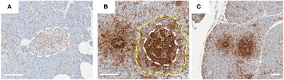 The role of the interferon/JAK-STAT axis in driving islet HLA-I hyperexpression in type 1 diabetes